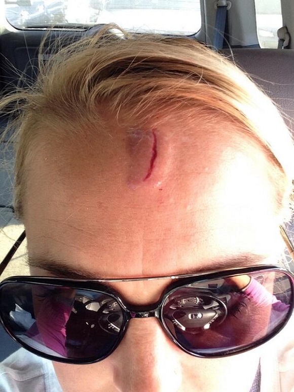 Jenny Grumbles has scar on forehead.